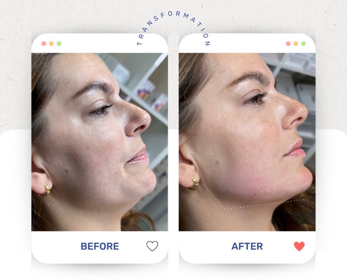 Before & After